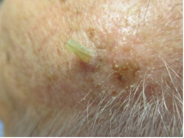 A cutaneous horn is shown.