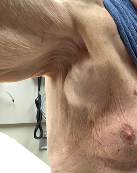 Figure 1. A presentation of right axillary mass is shown.
