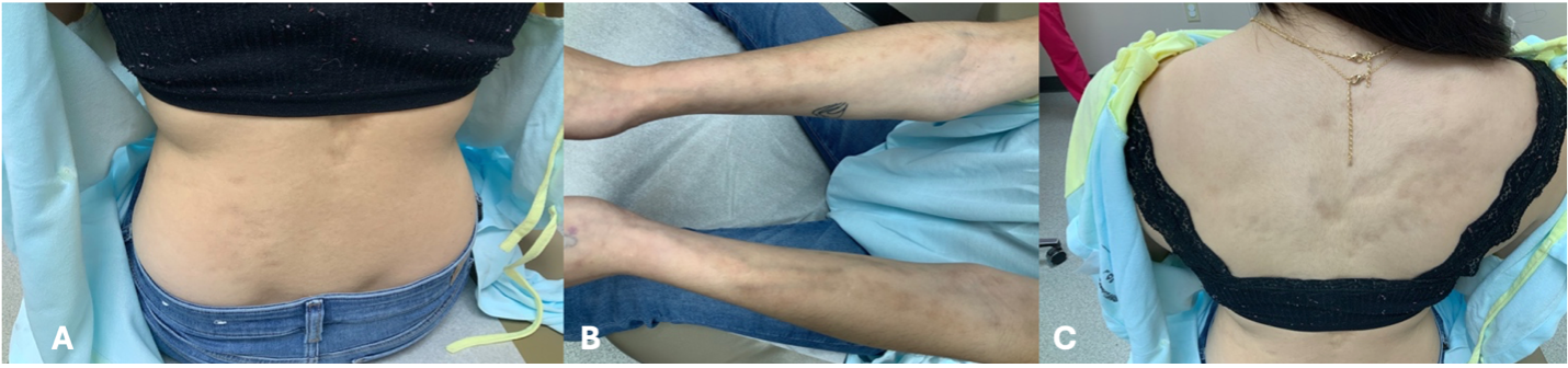 Figure 1A-C. Lesion presentation of suspected atrophoderma of Pasini and Pierini is shown.