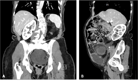 Figure 2. The CT of the abdomen and pelvis with contrast shows right hydronephrosis and hydroureter, (A) coronal view, (B) sagittal view.