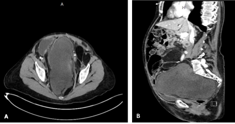 The CT of the abdomen and pelvis with contrast shows a heterogeneous pelvic lesion: (A) axial view, (B) sagittal view.