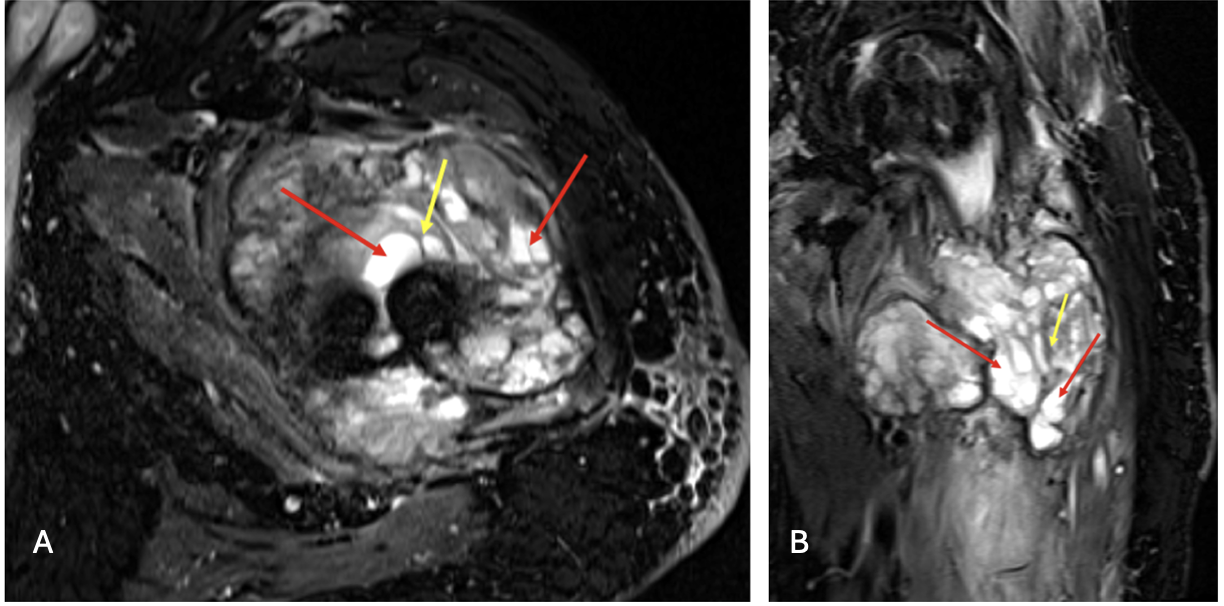 MRI STIR WARP axial (a) and coronal (b) images of the left femur. 