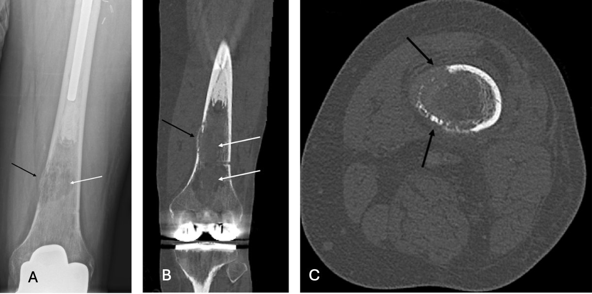Plain radiograph (a), coronal CT (b), and axial CT (c) of left distal femur. 