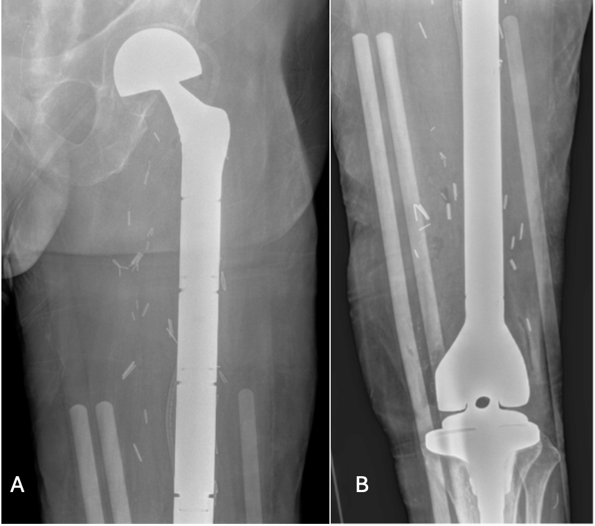 Plain radiograph of left femur. Postsurgical changes of left femur resection with megaprosthesis placement and articulating tibial component.
