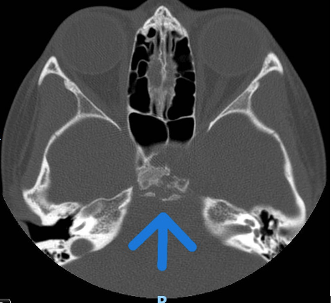 Initial computerized tomography. The maxillary sinus imaging revealed a suprasellar mass (arrow) is shown.