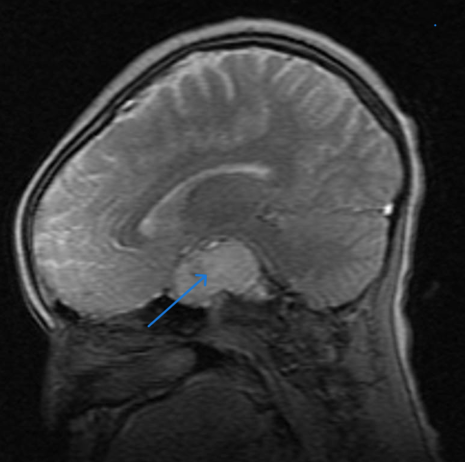 MRI of the sagittal section showing a suprasellar mass (arrow).