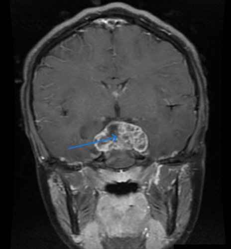 MRI of the coronal section shows a suprasellar mass (arrow).