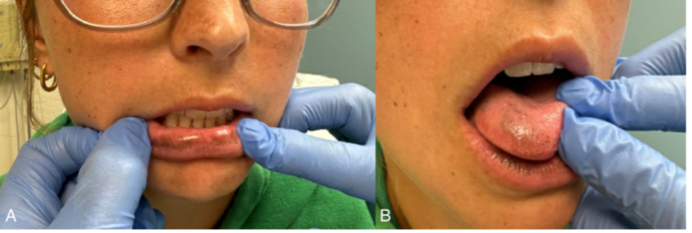 The patient presents with hyperpigmented macules on the lips, tongue, buccal mucosa, and gingiva.