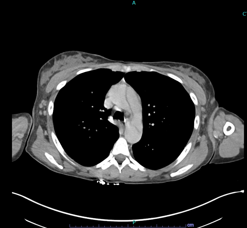 Computed tomography angiography (CTA) showing aortic dissection in a patient with systemic lupus erythematosus (SLE).