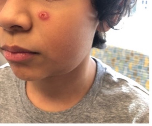 A boy's face with a small scratch under his right eye.