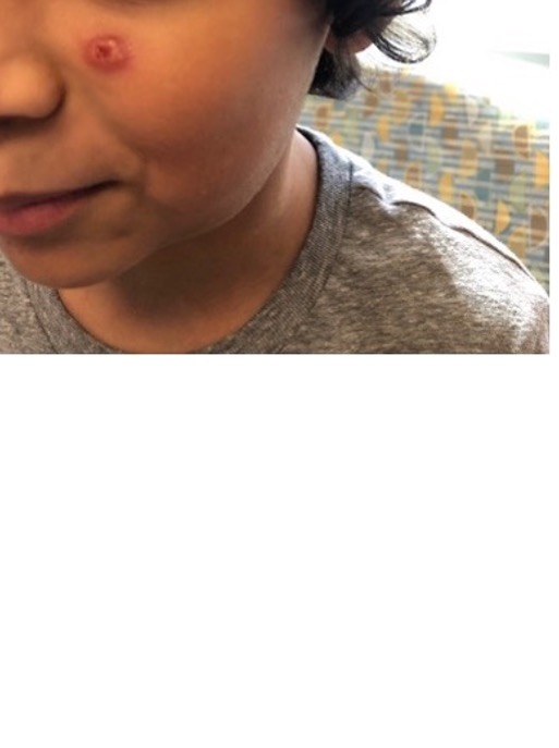 A close up of a boy's face with a small scratch under his right eye. 