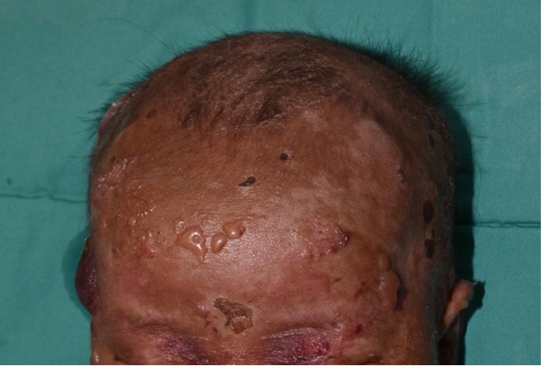 diffuse cutaneous mastocytosis
