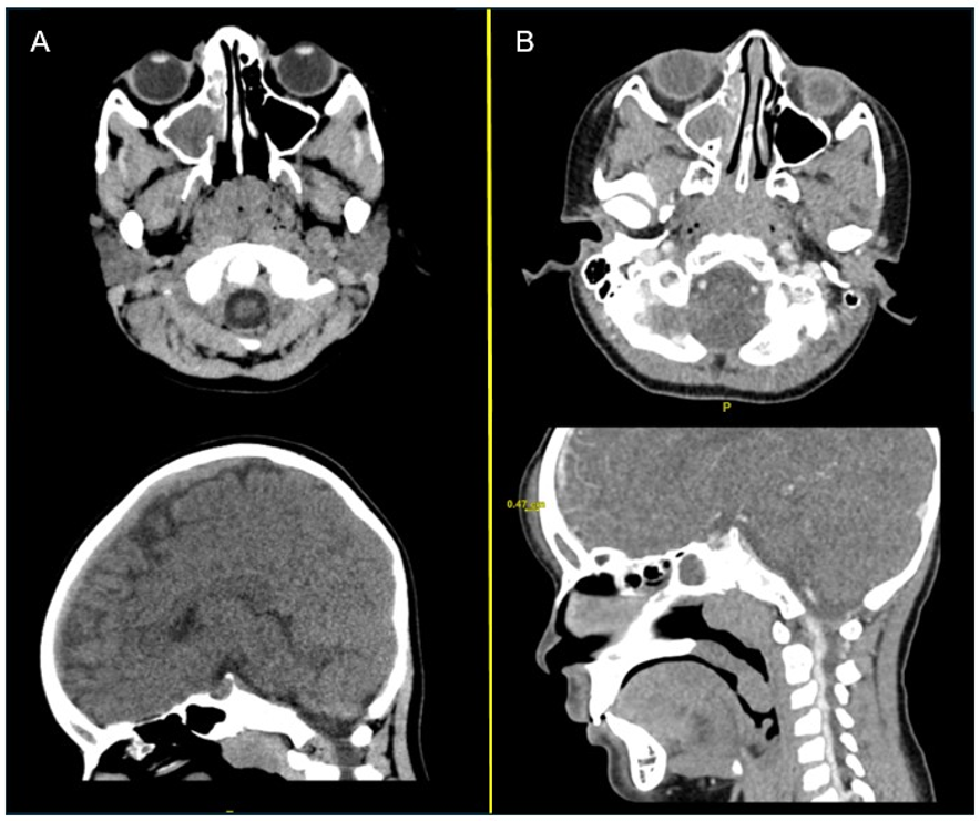 CT head non-contrast axial and coronal views during first visit to emergency department are shown. 