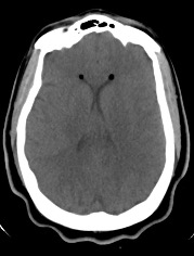 Nondependent pneumoventricle within the bilateral frontal horns of the lateral ventricles.