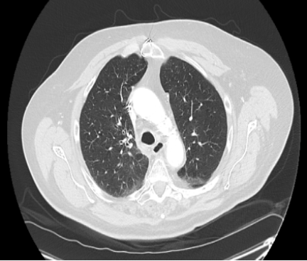 Chest CT, 1 month after finishing chemotherapy, showing near complete resolution of the mass. 