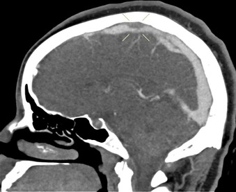 Short segment filling defect of the mid portion of the superior sagittal sinus.