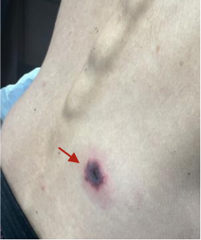 This image shows the patient’s back with 1.8 cm hemorrhagic plaque with central vesicles