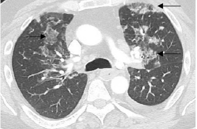 Transverse view of chest CTA illustrating multiple areas of ground glass consolidation (black arrows).
