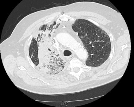 Chest CT after five cycles of Durvalumab showing a reappearance of RUL consolidation with air bronchograms.