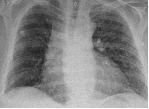 Portable CXR illustrating stable/improved pulmonary infiltration after the initiation of steroid therapy.