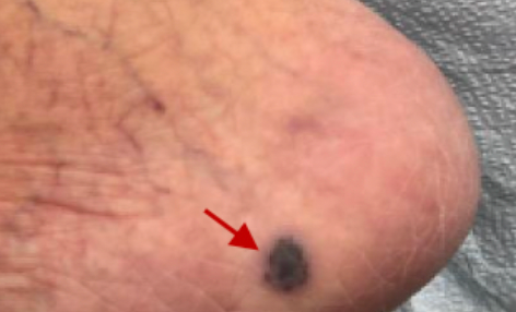 A right medial heel with 1 cm violaceous plaque is shown.