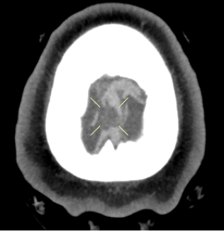 Figure 4. Axial view of the focal filling defect compatible with thrombus within the superior sagittal sinus.