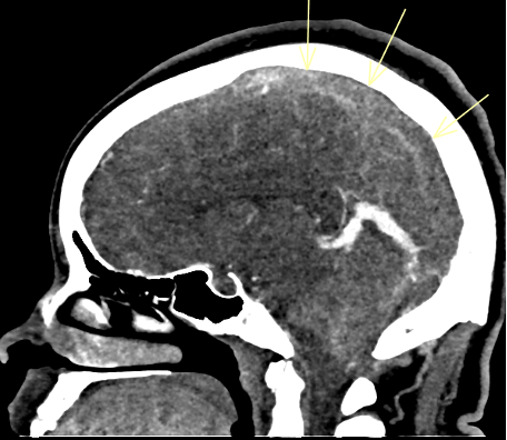 Complete occlusive thrombosis of the superior sagittal sinus.