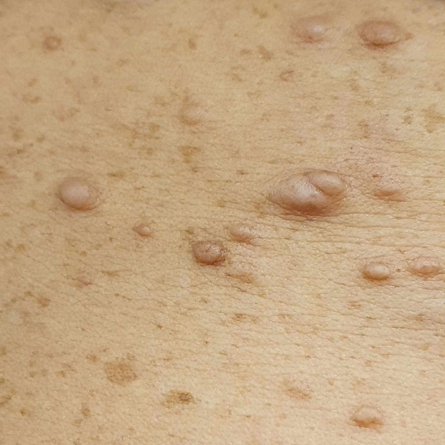 An Atlas of Lumps and Bumps, Part 30: Neurofibroma | Consultant360