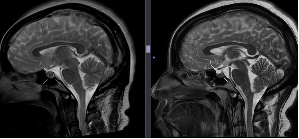 Figure 11. Initial brain MRI (left) shows enlargement of the pituitary gland, with resolution on follow-up MRI 6 months later (right).