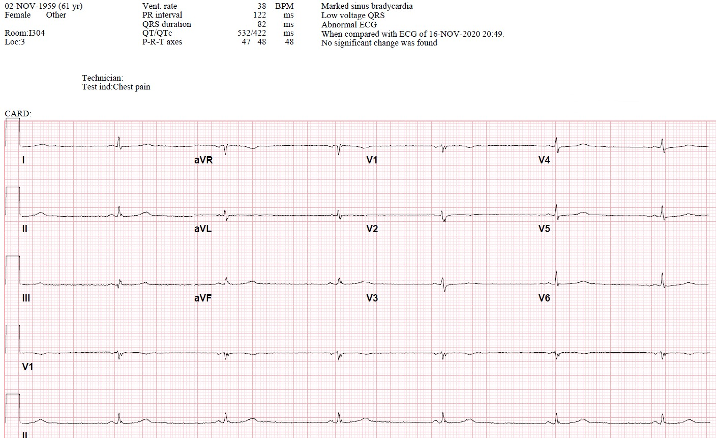 Marked sinus bradycardia after COVID-19 diagnosis. Ventricular Rate: 38 bpm.