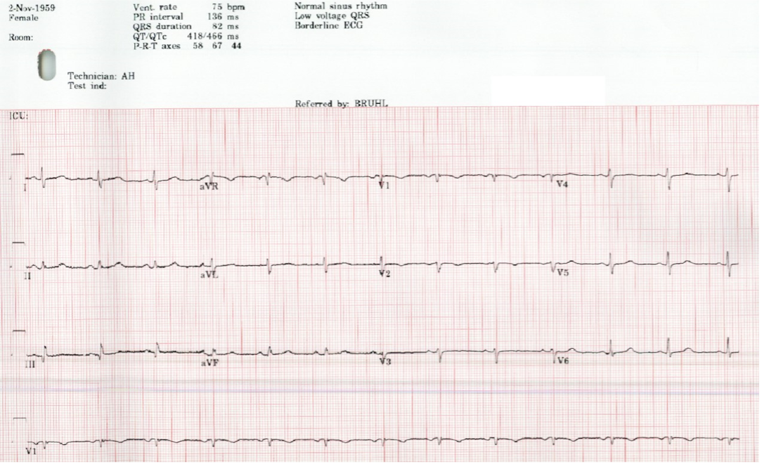 EKG of the patient following treatment for SARS-CoV-2 induced bradycardia. Ventricular rate: 75 bpm.