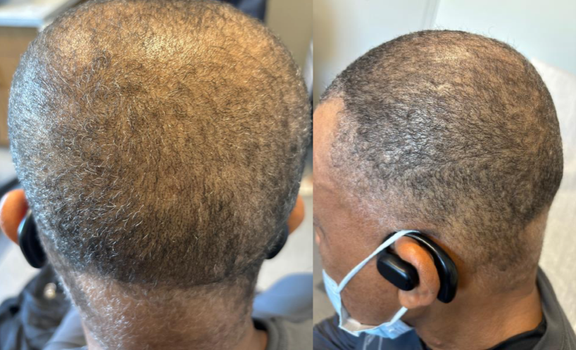 The patient showed significant improvement in alopecia after 9 months of 4 mg oral baricitinib.