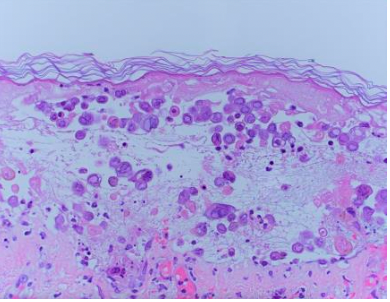An hematoxylin and eosin stain from a punch biopsy showing classic viral change: 