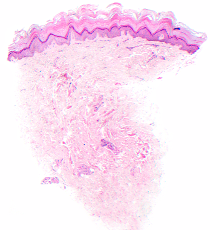 Figure 4. Histopathology, H & E stain, shown at 10x.