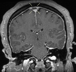 Figure 5. Postcontrast coronal T1 images confirm the superior sagittal sinus filling defect seen on CT.