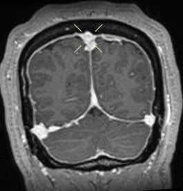 Figure 6. Rounding and distention of the superior sagittal sinus and bilateral transverse sinuses.