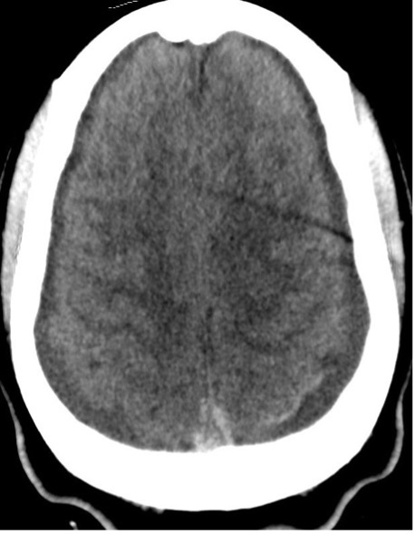 Figure 8. Development of bilateral cerebral convexity subdural hygromas.