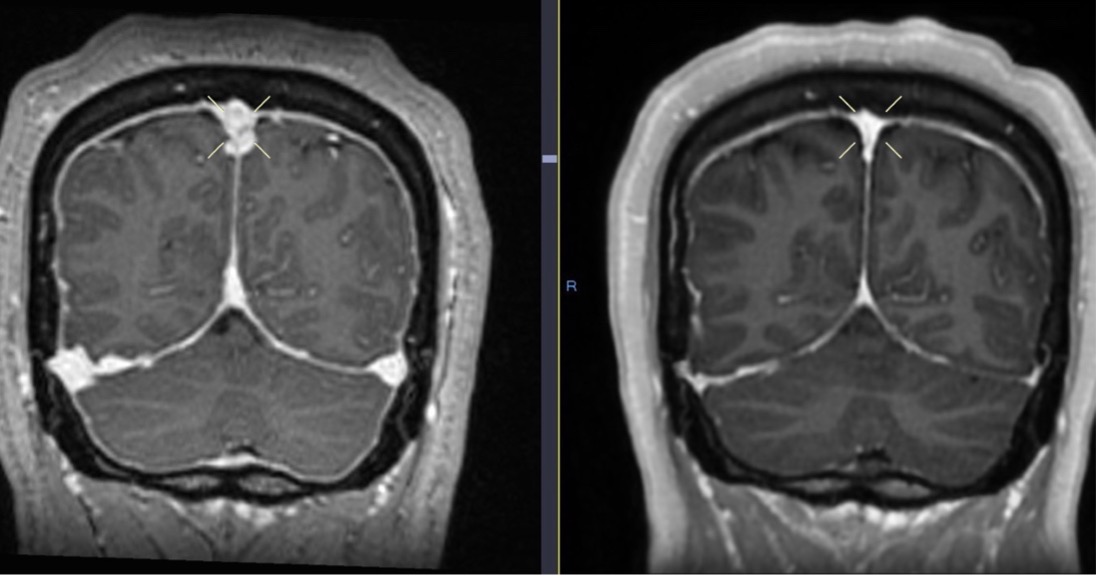 Figure 9. Initial brain MRI (left) shows distention of the cerebral venous sinuses, with subsequent resolution 6 months later on follow-up MRI (right).