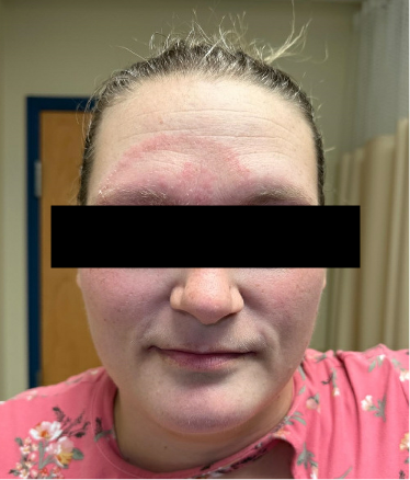 The patient presented with a rash that started on her abdomen, but spread to her face as well as her shins, groin, wrists, and arms.