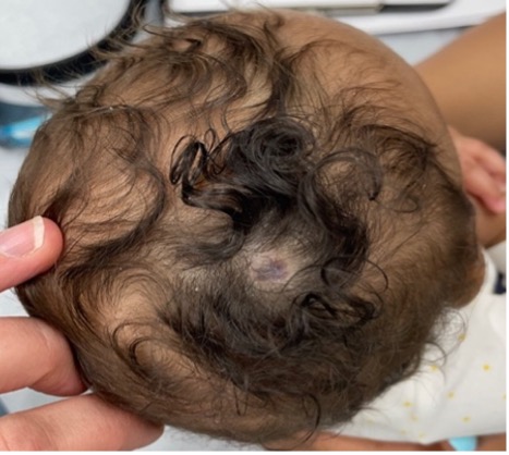 A lesion on the scalp of a 4-month-old infant is shown.