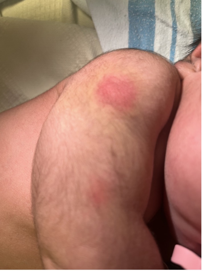 Two subcutaneous nodules were noted on the lateral right deltoid