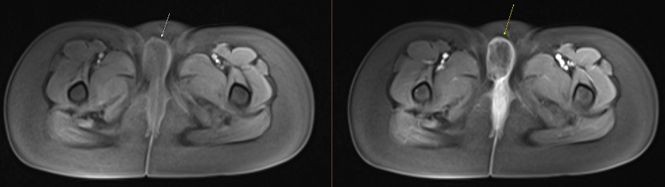 Pre (left) and Post-contrast (right) axial T1-weighted MR image 