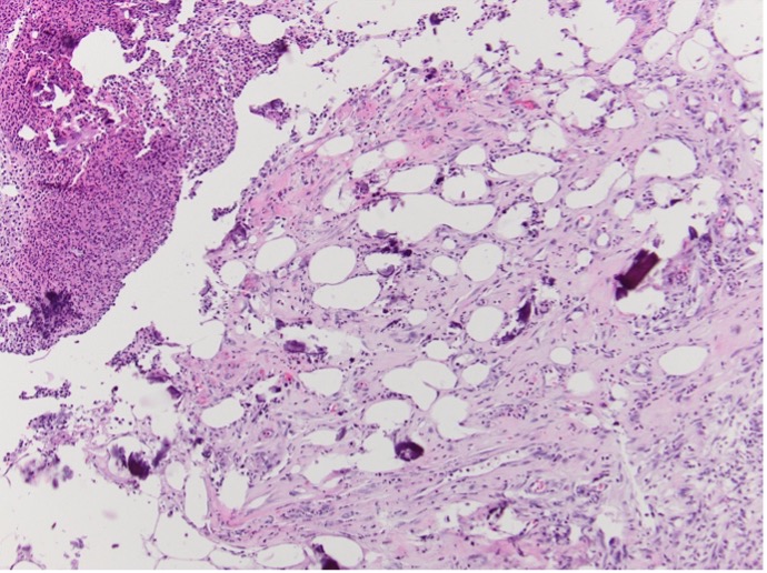 Ulceration extends into the panniculus. Calcification is noted (Hematoxylin-eosin-stained sections; original magnification x100).
