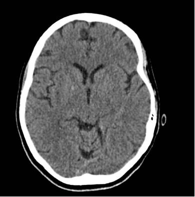 Figure 1. CT Head completed on day of initial admission. Findings significant for high density foci in the right global palladi that likely reflects calcification/mineralization