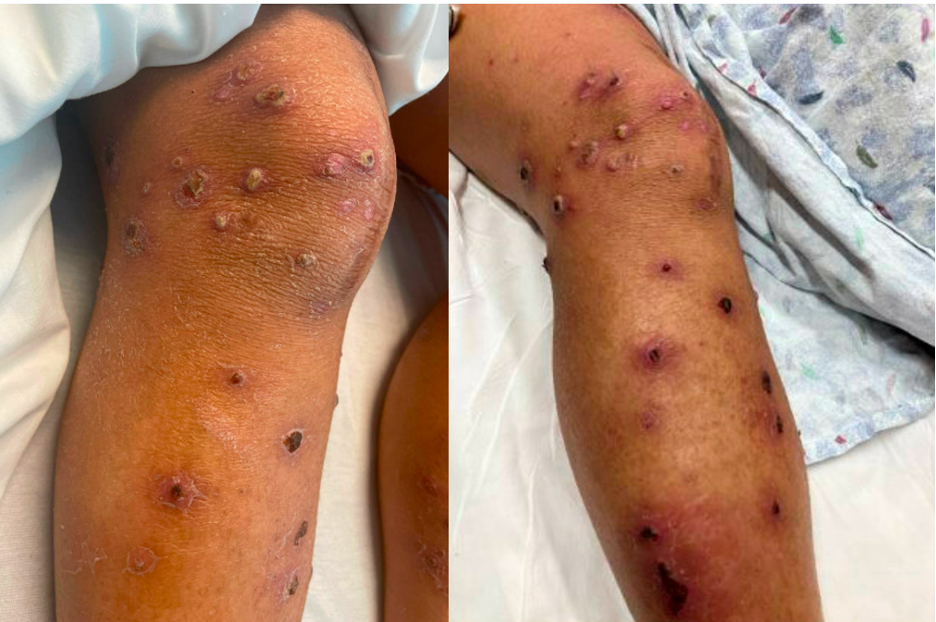 Discrete keratotic, pustular papulonodular lesions with central necrotic crust in differing stages of healing on the lower extremities.