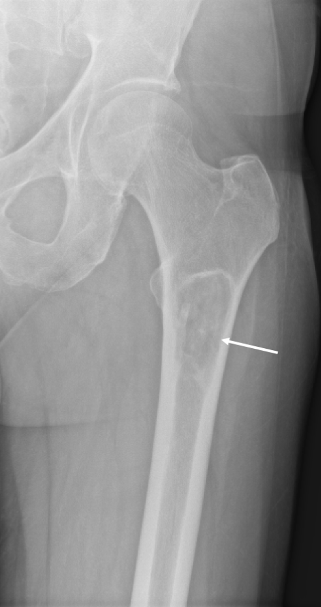 Initial plain radiograph of left proximal femur. Lucent lesion (white arrow) in the proximal left femur with cortical thinning.