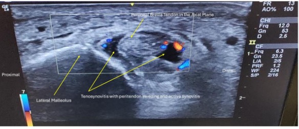 Short axis view of the peroneal brevis tendon demonstrated intense hyperemia and swelling indicative of tenosynovitis.