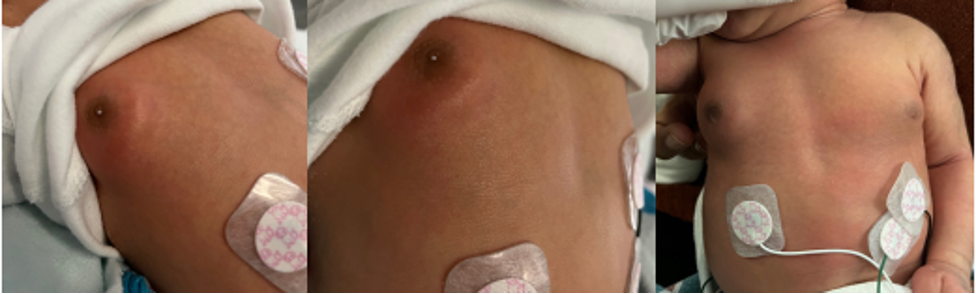Figure 1A-C. Erythema overlying right subareolar gynecomastia, with minimal white nipple discharge (A, B). Bilateral subareolar gynecomastia, right greater than left (C).