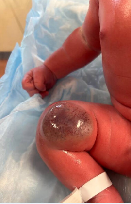 The lesion displayed a central area of telangiectasia surrounded by a thin peripheral rim of pallor, was warm to the touch, and slightly compressible.