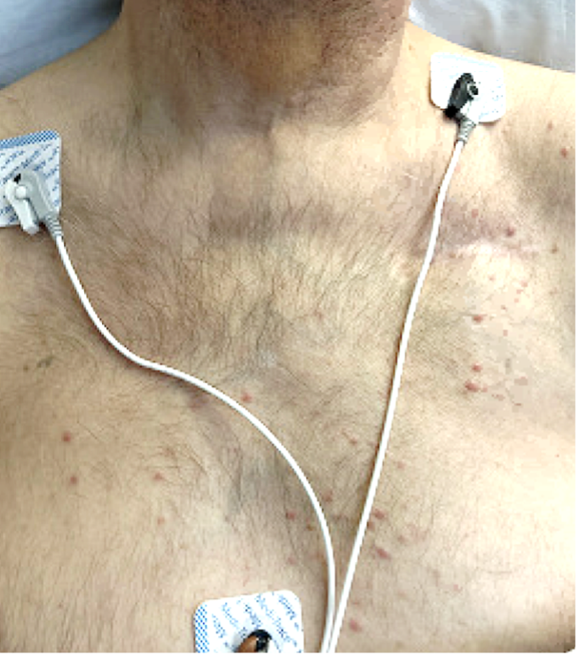 Figure 1. Diffuse pink perifollicular papules on the chest.